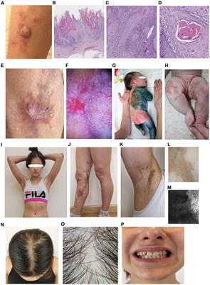 Case report: Variability in clinical manifestations within a family with incontinentia pigmenti